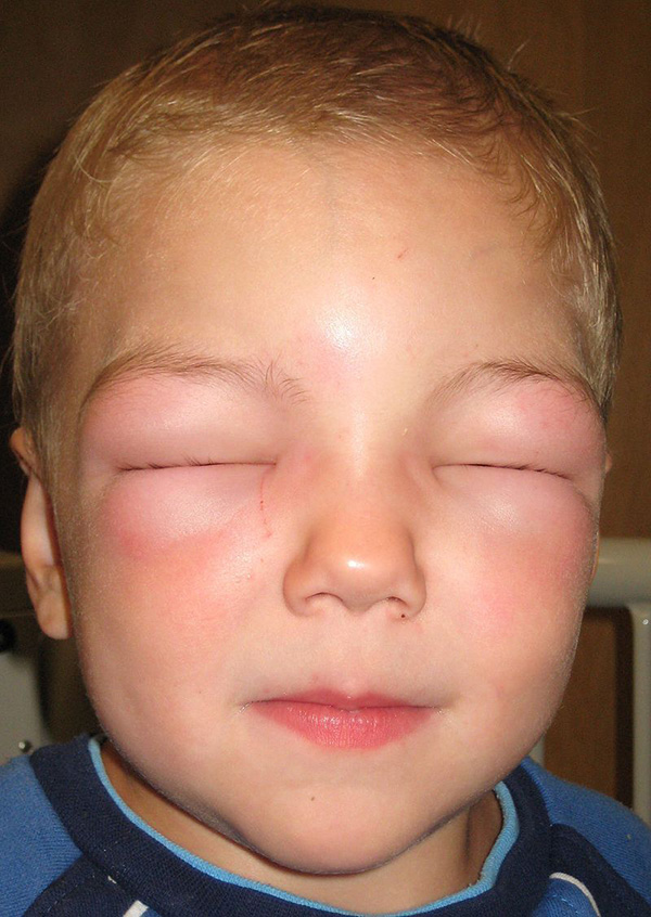 发生在眼部的血管性水肿(angioedema).
