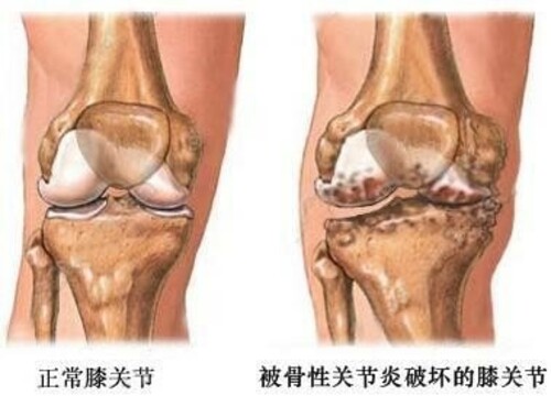 告别关节疼痛 丽之林干细胞注射疗法