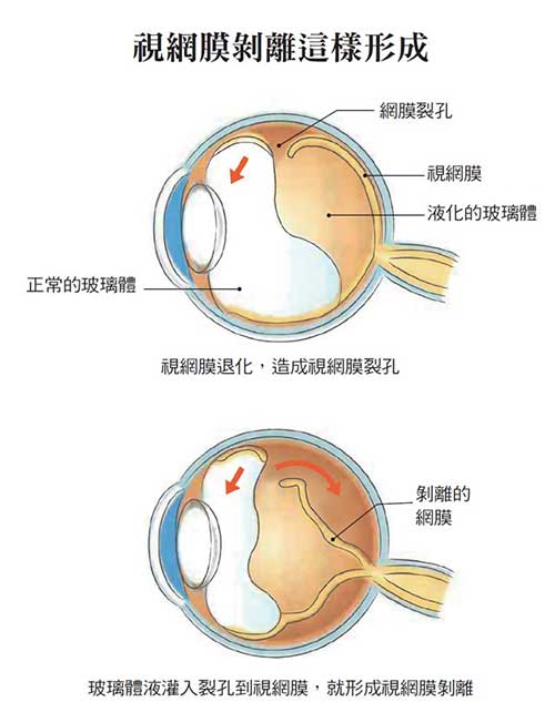 视网膜剥离四大警讯你一定要知道