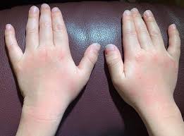 过度清洁双手或致湿疹 医生提3个洗手重点 