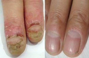 【医疗】灰指甲手足癬專科診所 对病人耐心仔细，治愈了许多病人的灰指甲和皮肤癣!