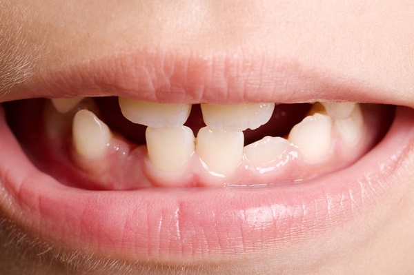 【牙科】索羅門牙醫之旅 | 牛錫麟兒童牙科專科醫生