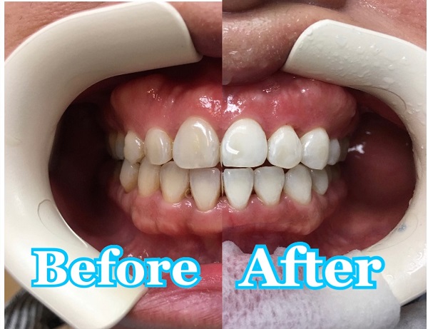 【牙科】夏季牙齒美白優惠活動 | 美國牙科學院