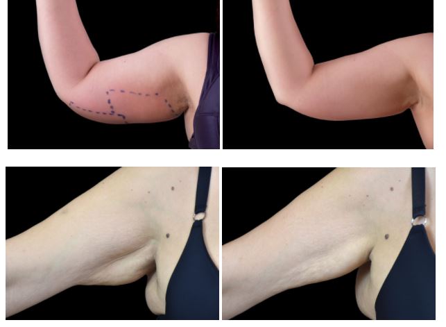 【樂沙醫美容中心】愛麗絲智能超頻（BTL Exilis Ultra）- 最新代英國皇家御用原裝進口、 360度全方位超頻除紋緊膚減脂儀