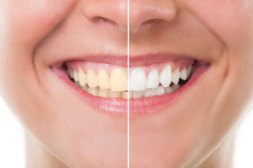 【牙科】什麼是種植牙? 缺失牙有幾種修復方式？植牙要花多少錢？ | 鑽石吧李晶晶牙周病專科