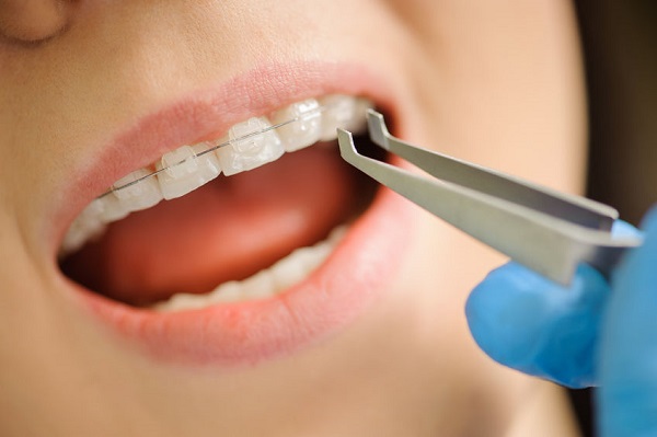 牙科保險：如何挑選个人家庭牙科保險 | 2021牙科保险指南| 鑽石吧李晶晶牙科
