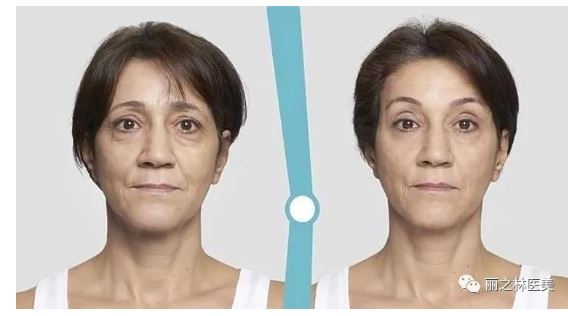 【醫美】360度”鈴鐺線”線雕, 完美的面部提升! | 麗之林醫學美容中心