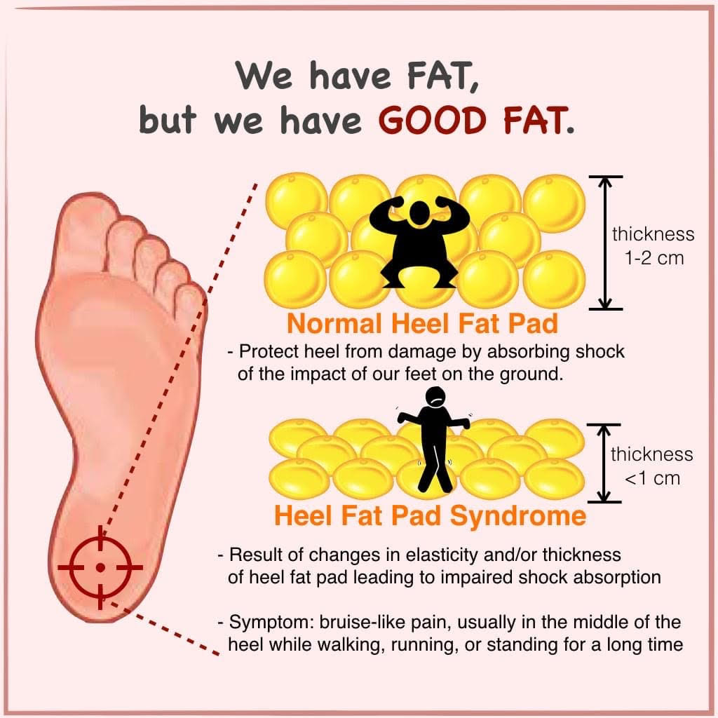 【健康】你知道我們的腳跟下原來也有一層脂肪嗎？| 布朗朵莉足健康公司