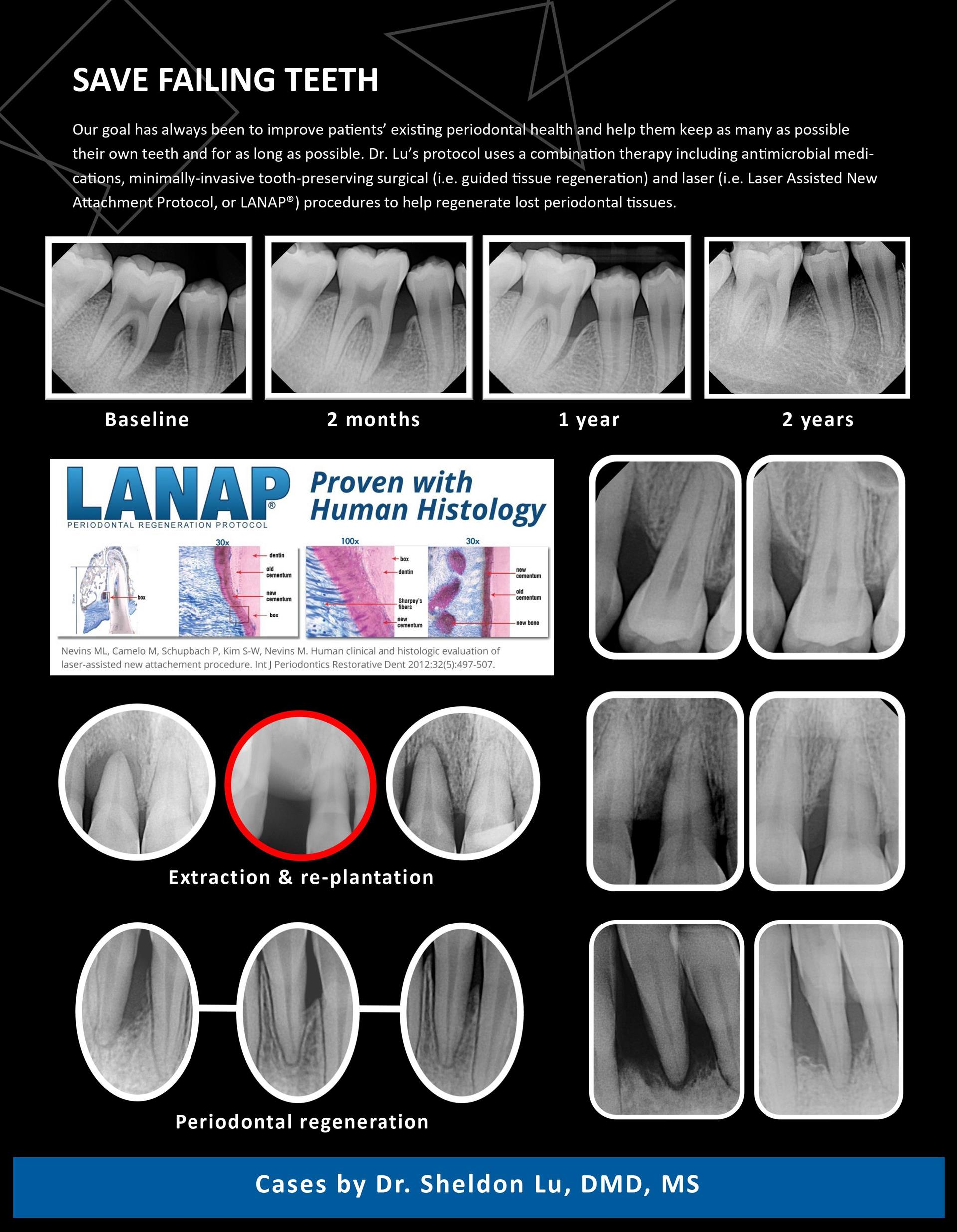 盧嘯晨牙周/植牙專科：拯救即將脫落的牙齒 Save failing teeth