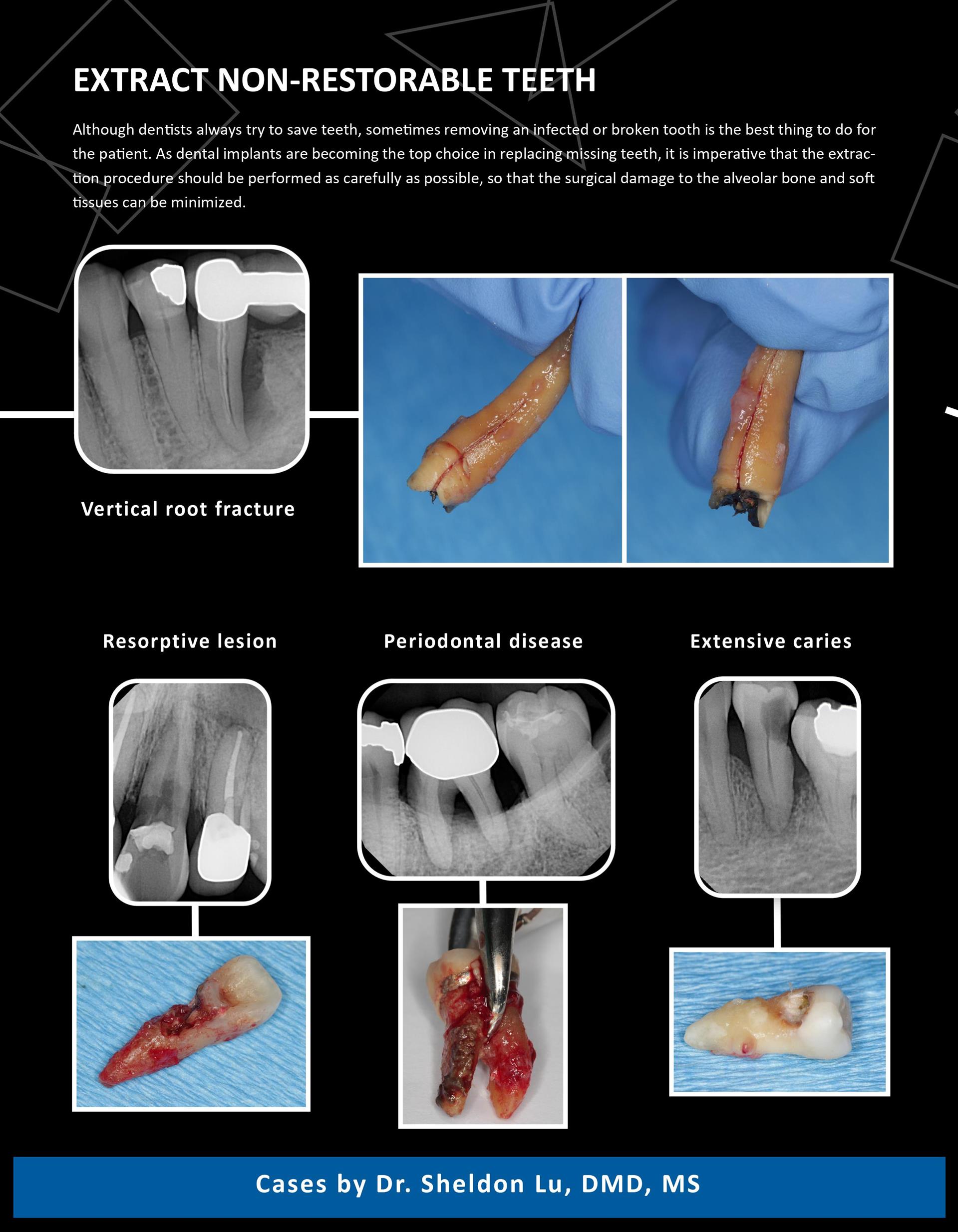 盧嘯晨牙周/植牙專科：拔出不可修復的牙齒 Extract non restorable teeth