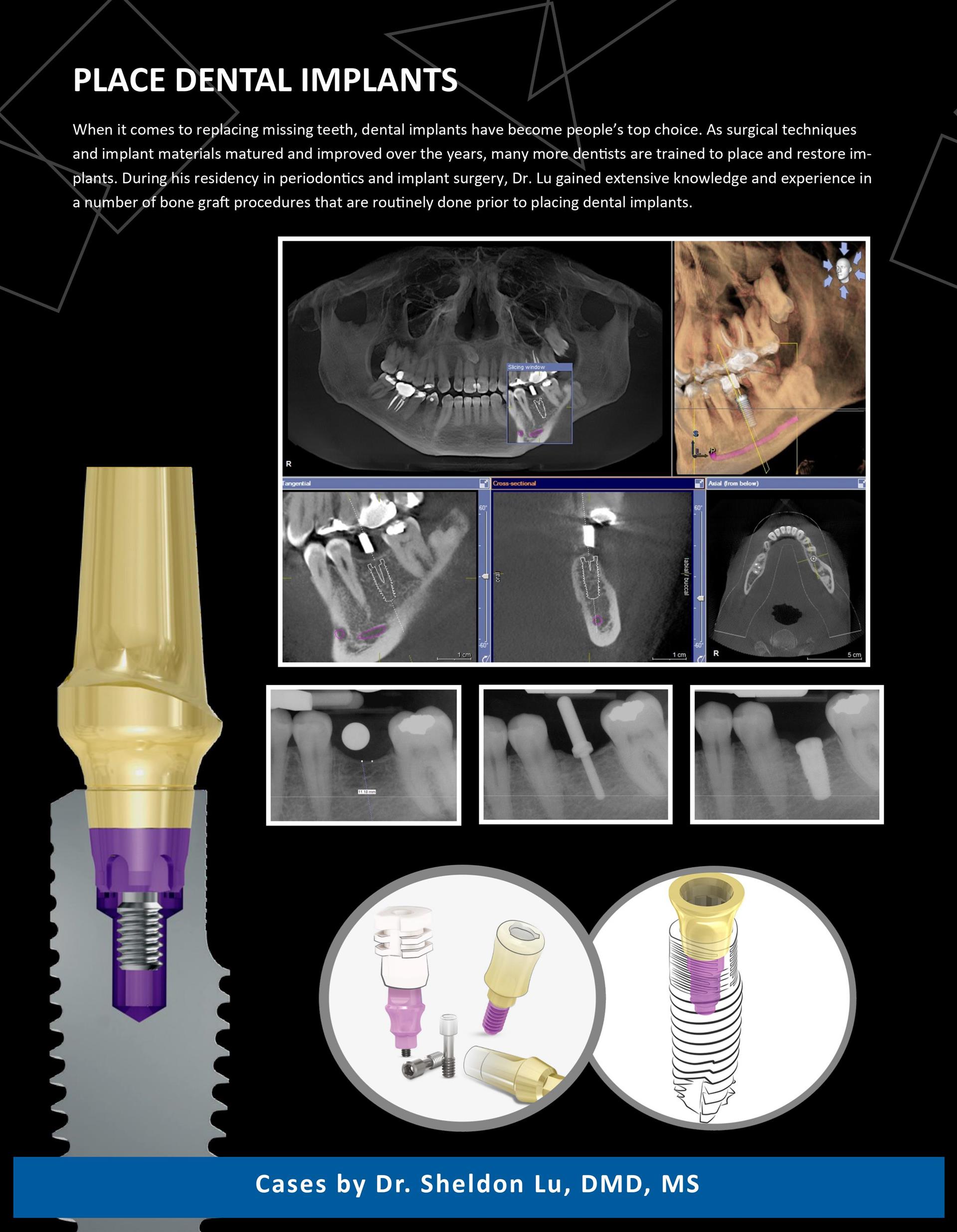 盧嘯晨牙周/植牙專科：植牙專業經驗 Place dental implants