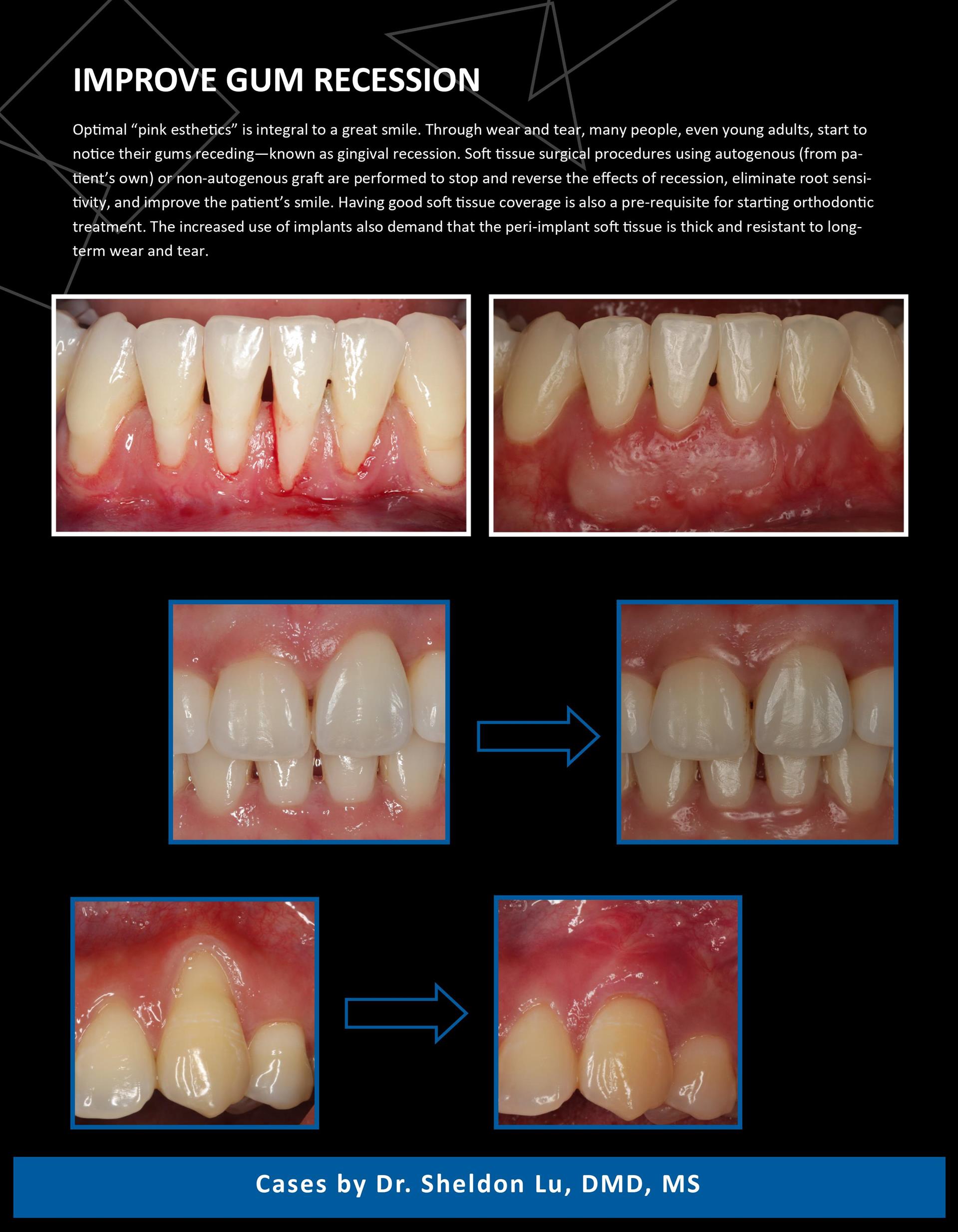 盧嘯晨牙周/植牙專科：改善牙齦萎縮 Improve gum recess