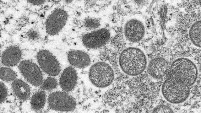 美国首次确认2例儿童猴痘病例，其中1例在加州
