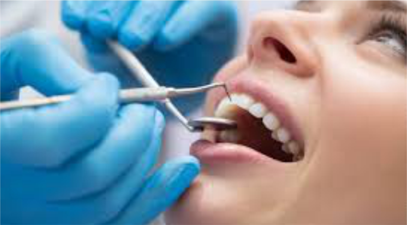 SF灣區矽谷「種植牙、植骨手術」牙醫診所推薦 - 向喜林牙醫博士