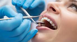 灣區矽谷「根管治療」牙醫診所推薦 - 向喜林牙醫博士