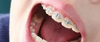 儿童矫正牙齿的误区有哪些？