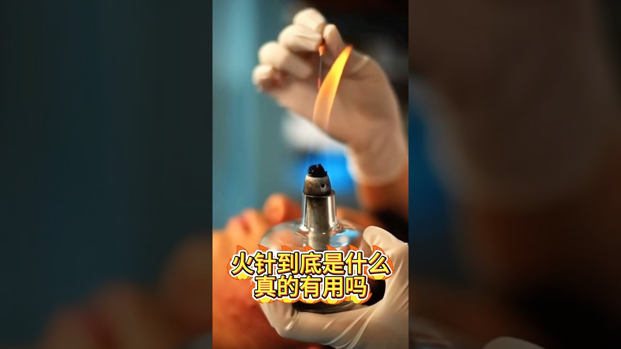 两分钟了解火针！真的对皮肤有用吗？