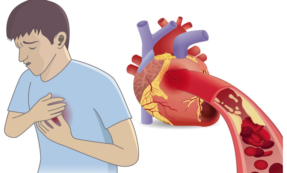 【养生】90分钟生死时速！别把心肌梗塞误当“太累了”！ | 美国贝佳天然药业