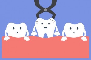 拔牙后注意事项