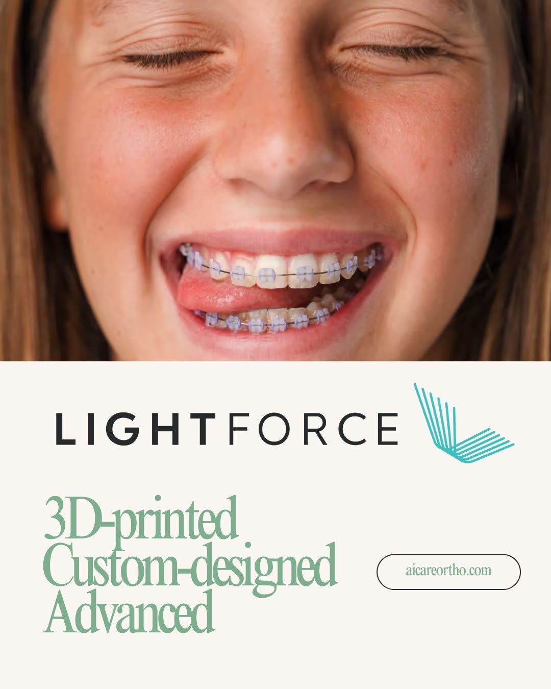 【齿列矫正】使用LightForce牙套体验齿列矫正的未来——世界上第一个完全定制的3D列印牙套系统！