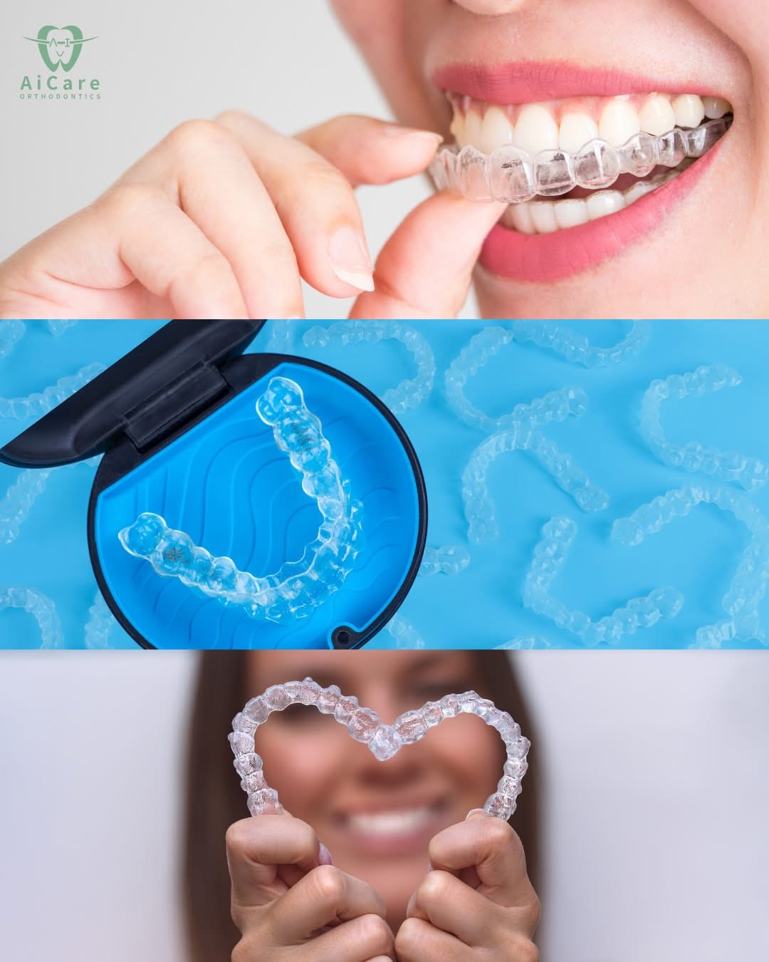 【齿列矫正】Invisalign 隐形牙套，让你的笑容在清晰、舒适中悄悄变美！｜黄艾齿列矫正专科