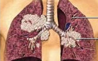 【美国希望之光医疗】Nivolumab(Opdivo)和易普利姆玛（Ipilimumab, Yervoy）组合治疗非小细胞肺癌的新进展