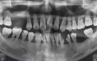 標準齒科醫院：牙周炎會偷偷吃掉你的骨頭