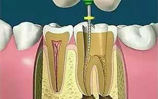 標準齒科醫院：“根管治療”是不是就是“抽牙神經”？