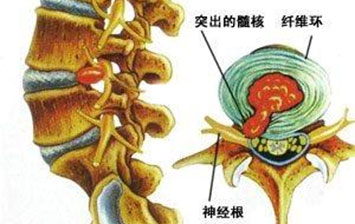 許德立醫師：針灸治療腰椎間盤突出